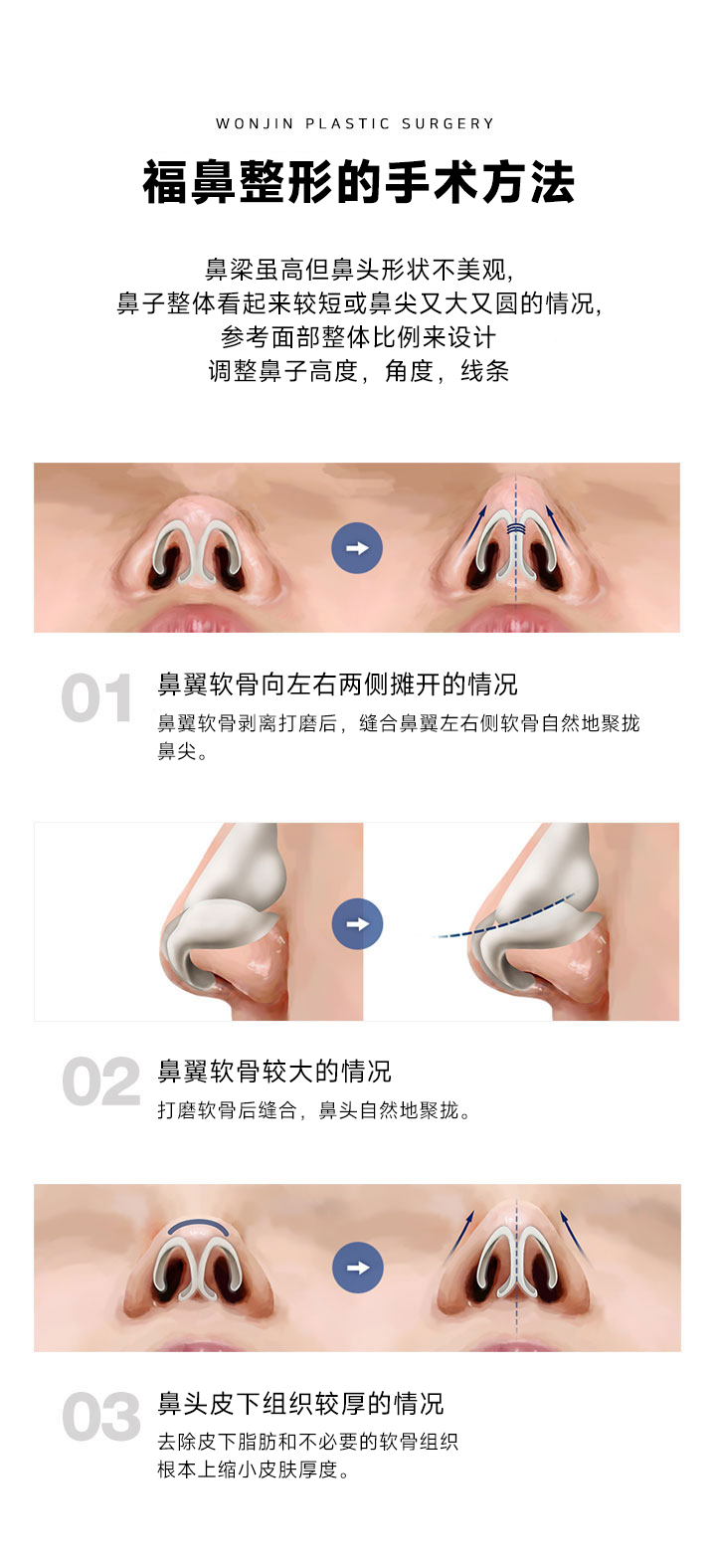 복코성형의 수술 방법
				콧대는 높지만 코 끝모양이 예쁘지 않아 코가 짧아 보이거나 길어 보이는 경우, 또는 코 끝이 뭉뚝한 경우 등에 시행하며
얼굴 전체의 조화에 맞게 높이, 각도, 라인을 섬세하게 조절하여 디자인합니다.
1 코 끝의 날개 연골이 좌, 우로 벌어져 있는 경우
날개 연골을 박리하여 작게 다듬은 후 벌어진 날개 연골의 
좌, 우측을 봉합하여 자연스럽게 코 끝을 모아줍니다.
2 코 끝의 날개 연골이 큰 경우
연골을 작게 다듬어 양쪽을 봉합하여 콧볼을
자연스럽게 모아줍니다.
3 코 끝 피하조직이 두꺼운 경우
피하지방과 불필요한 연부조직을 제거하여 근본적인 
피부의 두께를 줄여줍니다