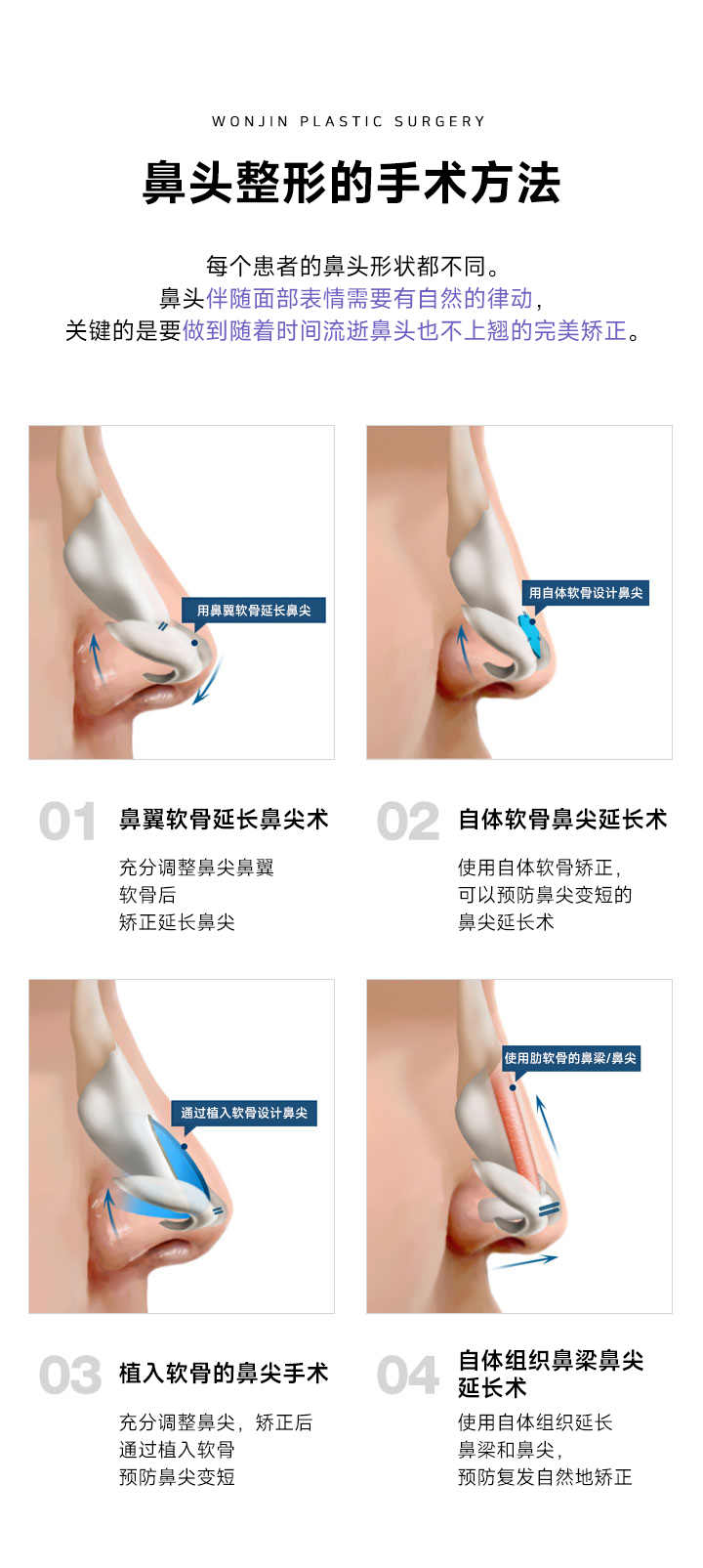 코끝성형의 수술 방법
				환자마다 가지고 있는 코끝 모양은 다릅니다. 코끝은 얼굴의 표정에 따라 자연스러운 움직임이 있어야 하며
시간이 지나도 코 끝이 들리지 않도록 완벽하게 교정하는 것이 중요합니다. 
1 코끝 날개연골을 이용한 코끝연장술
코끝날개연골을 충분히 이완한 후
고정하여 코끝을 연장
2 자가연골을 이용한 코끝연장술
자가연골을 이용한 고정으로 
코끝이 짧아지는 현상을 예방하는
코끝연장술
3 연골삽입을 통한 코끝수술
코끝을 충분히 이완, 교정후 
연골삽입으로 코끝이 짧아지는 
현상을 예방
4 자가조직 이용한 콧대+코끝연장
자가조직을 이용하여 콧대와 코끝을
연장, 재발을 막고 자연스럽게 고정