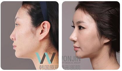 韩国鼻子修复