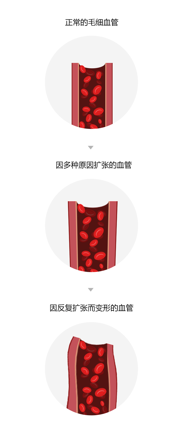 毛细血管扩张病理示意图：正常血管vs扩张血管对比