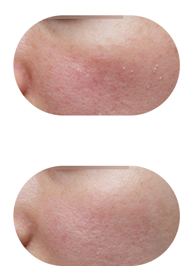 痤疮治疗案例1：炎症痤疮+痘印综合改善效果