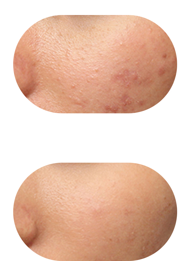 痤疮治疗案例2：治疗前后对比（炎症消退90%）