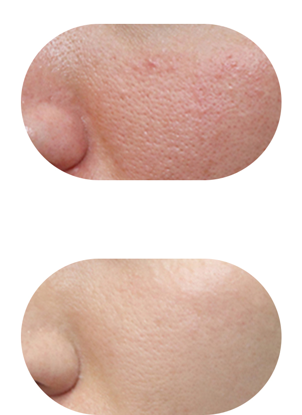 痤疮治疗案例3：治疗前后对比（痘印淡化85%）