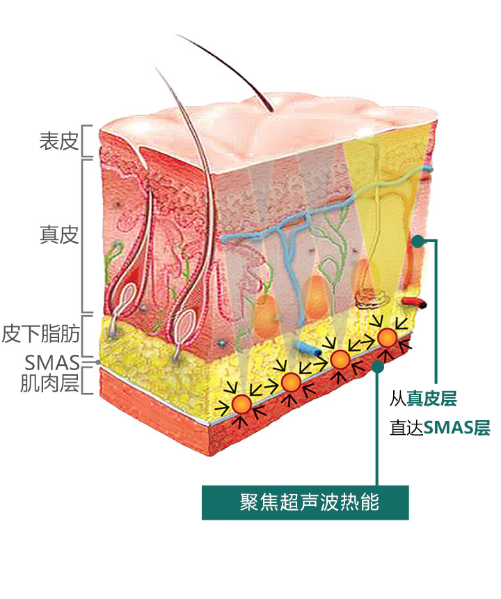 超声能量聚焦原理图