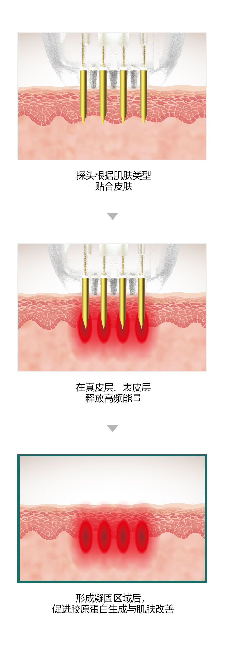 微针深度调节及能量传导示意图