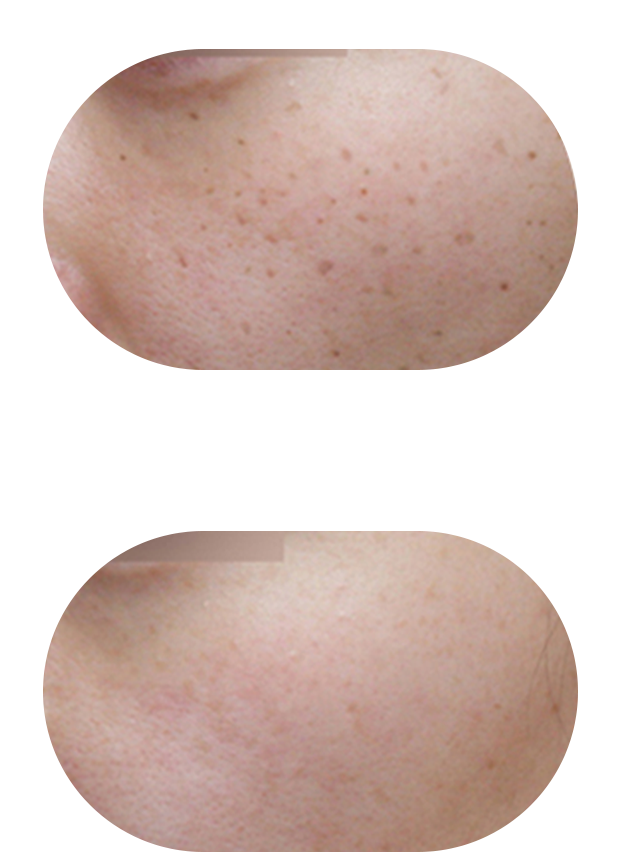 色素管理案例1：肤色提亮+毛孔隐形+弹性恢复综合改善效果