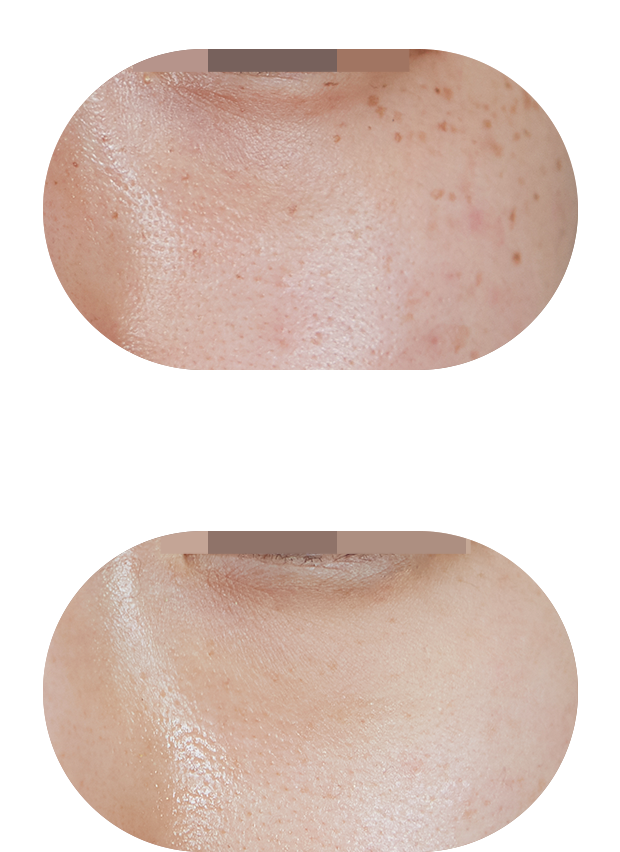 色素管理案例2：治疗前后对比（色斑淡化80%）