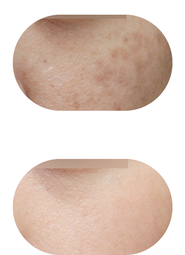 色素管理案例3：治疗前后对比（肤质细腻度提升65%）